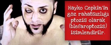 Hayko Cepkin’in gözündeki farklılığın sebebi nedir?