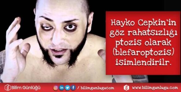 Hayko Cepkin’in gözündeki farklılığın sebebi nedir?